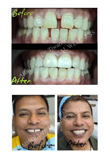 Smile Transformation 3